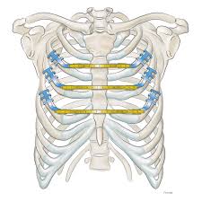 Interactive tutorials about the ribs and sternum bones, with labeled images and diagrams featuring the beautiful illustrations of getbodysmart. Sternal Closure Stratos Medxpert