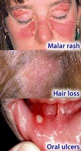 Skin Lesions Oral Ulcer Ulcers Autoimmune