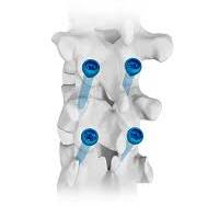 Percutaneous MIS Facet Screw.Double Medical - SPINEMarketGroup