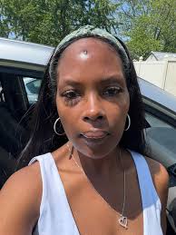 Help please! I had a jaw tumor. After multiple surgeries and lots of going  back and forth my gum has finally healed. I have no bone from the teeth