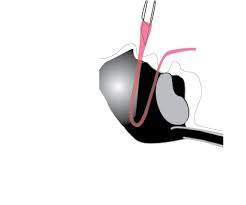 Image result for Intubation Associated Sinusitis