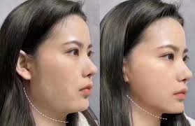 你可以不信面部风水! 但太阳穴一定不能凹! 从风水来说，夫妻宫饱满、 太阳穴饱满，旺夫又旺财😍 重点是你更好看更显年轻了！  ​10分钟恢复太阳穴凹陷问题​