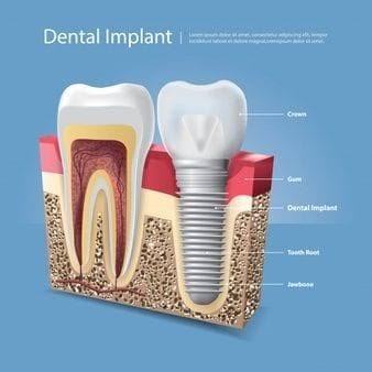 Implants product image