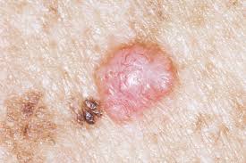 Lung cancer has two broad types: Skin Cancer Oncology Nurse Advisor