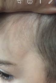 War der aufprall jedoch stark. Beule An Stirn Seit 10 Tagen Kinder Kleinkind Kinderarzt