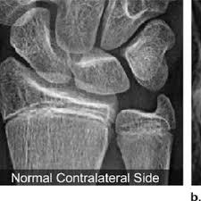Image result for Growth Plate