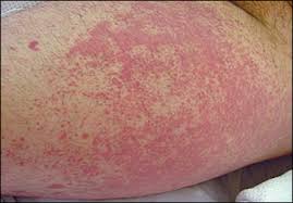 Arthritis, gastrointestinal involvement, kidney inflammation, and purpura. Localized Rash After Skin Exposure To Cold Temperature Photo Quiz American Family Physician