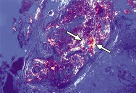 Image result for Broncholithiasis