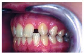 Image result for ochrana chrupu