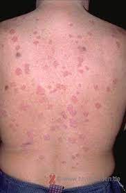 Discover more about the stages of hiv infection. Psoriasis Hiv Und Aids