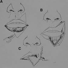 Durgun m., eker e., tellioğlu t. Lip Reconstruction Facial Plastic Surgery Clinics