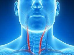 Sometimes, when arteries become completely blocked, a new blood supply develops around the blockage. Narrowing Of The Carotid Arteries May Lead To Memory And Thinking Problems