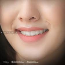 Top 8 địa chỉ bọc răng sứ thẩm mỹ uy tín tại quận 3, TP.HCM