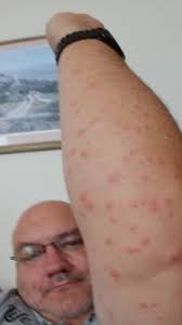 Mosquitos in Oakland are aggressive