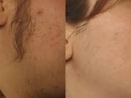 Lundeby, please send an email or call. 8 Best Laser Hair Reduction Ideas Laser Hair Reduction Hair Reduction Depilatory