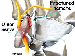 Image result for Hamate Bone