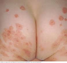 Image result for Impetigo