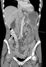 Image result for Adult Intussusception