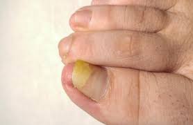 Image result for Yellow nail syndrome feet