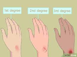 They usually do not need intensive medical treatment unless they cover a large area or show signs of infection. 3 Ways To Treat A Serious Burn Wikihow