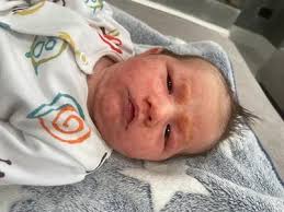 Image result for yellow scabs on the face in children