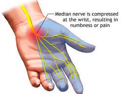 Carpal Tunnel Syndrome Often Seen Too Often Missed Clinica Sandalf Benalmadena Costa Del Sol