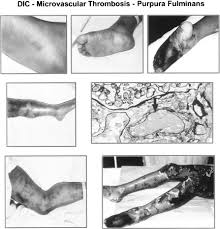 Purpura fulminans is a severe and rapidly fatal form of acute dic. Coagulation Dysfunction In Sepsis And Multiple Organ System Failure Critical Care Clinics