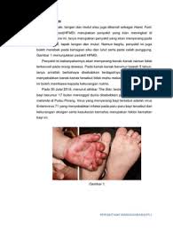 Coxsackievirus infections can spread from person to person. Case Study Hfmd