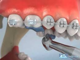 The dentist put 'bite blocks' on my 1st lower molars, like white material to build them up to stop me biting down on the brackets. Deep Bite Posterior Turbos Youtube