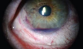 Image result for Hyphema