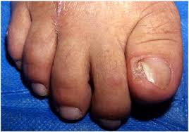 Image result for Onychotillomania feet