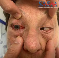 Image result for Proptosis