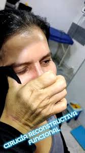 Reconstructiva Funcional!!! Agéndate al 3108826919...no hay hora o valor de  tu bienestar! #rino #colombia #otorrino #nariz #confianza #neiva