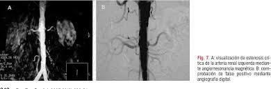 Learn vocabulary, terms and more with flashcards, games and other study tools. Aneurisma De Aorta Abdominal Y Enfermedad Vascular Renal Semantic Scholar