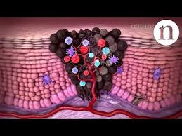 Tumour Immunology And Immunotherapy Youtube Immunotherapy Cancer Immunotherapy Immunology