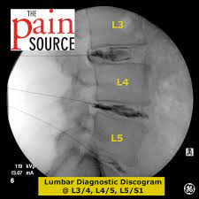 Lumbar Discography The Pain Source Makes Learning About Pain Painless