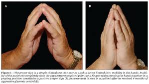 Pointing Out The Facts Diabetes Stiff Hand Syndrome Dshs Well Life Medical