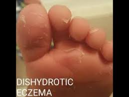 Image result for pompholyx soles of feet