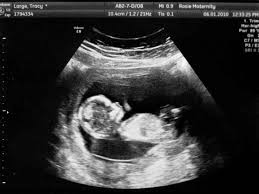 The 12 Week Scan When You See Your Real Actual Child For The First Time Is The Most Awe Inspiring Thing You Ll Witness In 2020 Girl Ultrasound Pictures Ultrasound Pictures 12 Week Scan