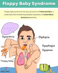 Image result for Floppy Infant