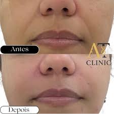 ⚜️ Harmonia Preenchimento com Ácido Hialurônico para definição dos  contornos faciais.