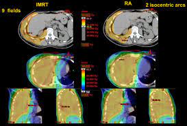 We did not find results for: Volumetric Modulation Arc Radiotherapy Compared With Static Gantry Intensity Modulated Radiotherapy For Malignant Pleural Mesothelioma Tumor A Feasibility Study International Journal Of Radiation Oncology Biology Physics