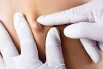 Female Infected Ingrown Pubic Hair