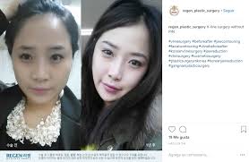 Día uno de #bichectomia y #rinoplastia todo increíble. Como Adelgazar El Rostro Con Cirugia Y Sus Consejos Para Rebajar Tu Fisonomia Sin Apelar A La Cirugia