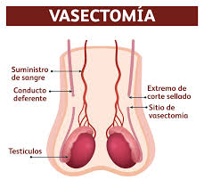 La vasectomía o deferentectomía consiste en la sección y ligadura de los conductos deferentes. Como Se Realiza La Vasectomia Convencional Y Sin Bisturi