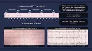 This is known as an escape rhythm. Third Degree Atrioventricular Block Ecg Youtube