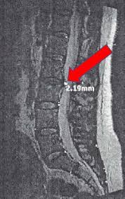 Maybe you would like to learn more about one of these? Herniated Disc Settlements Car Accidents And More