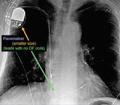—— magnets placed over icds affect. Cxr Iii Springerlink
