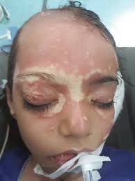 Wrong Use of Oxygenated Water to Preparation the Skin before Surgery