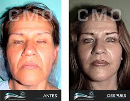 Rejuvenecimiento Facial